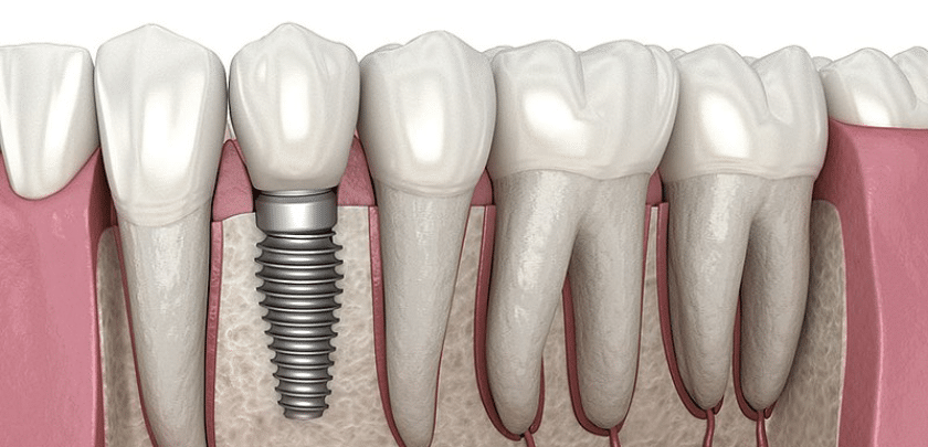 Dental Implants