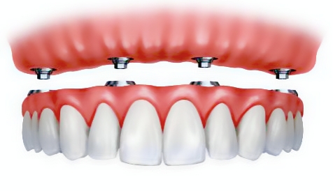 Full Mouth Rehabilitation