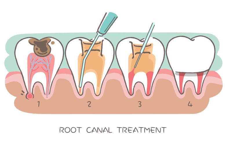 Root Canal