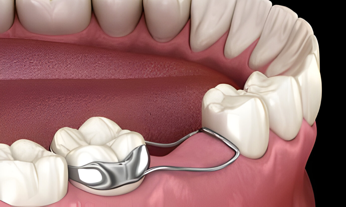 Dental Implants