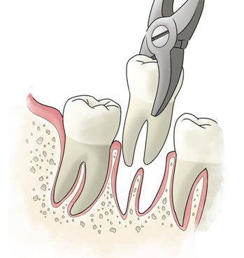 Full Mouth Rehabilitation
